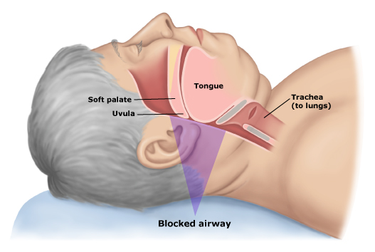 sleepapnea