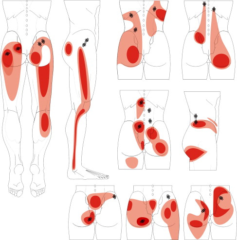 myofascial