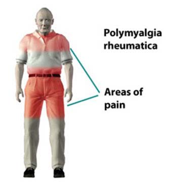 polymyalgia