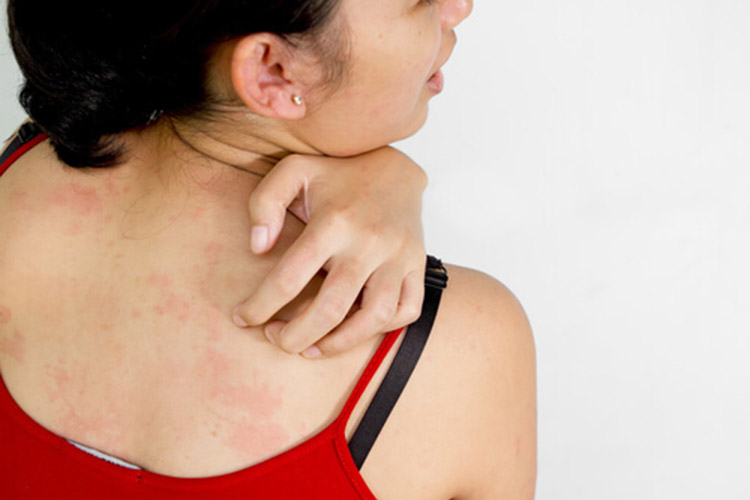 chronic skin rashes that itch