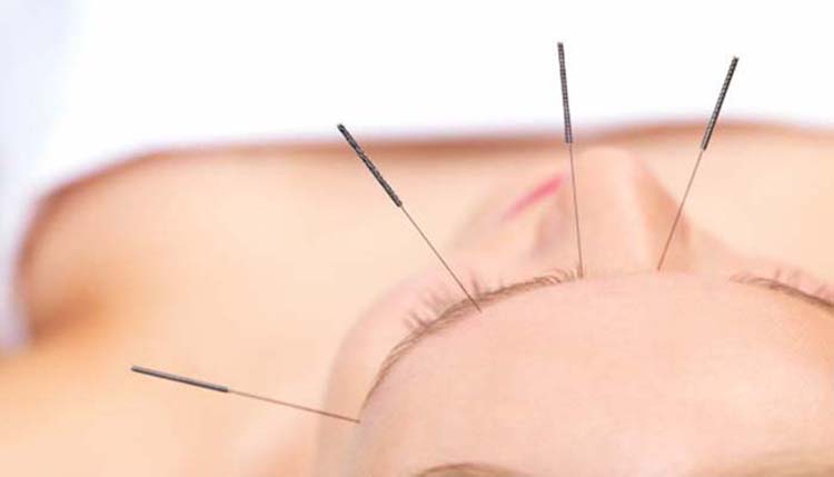 acupuncture