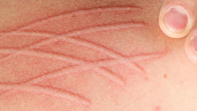 What You Need To Know About Fibromyalgia Skin Disorders