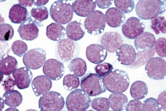 epstein-barr virus cause fibromyalgia