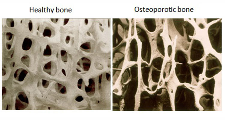 Healthiculture - Can Fibromyalgia Cause Osteoporosis?