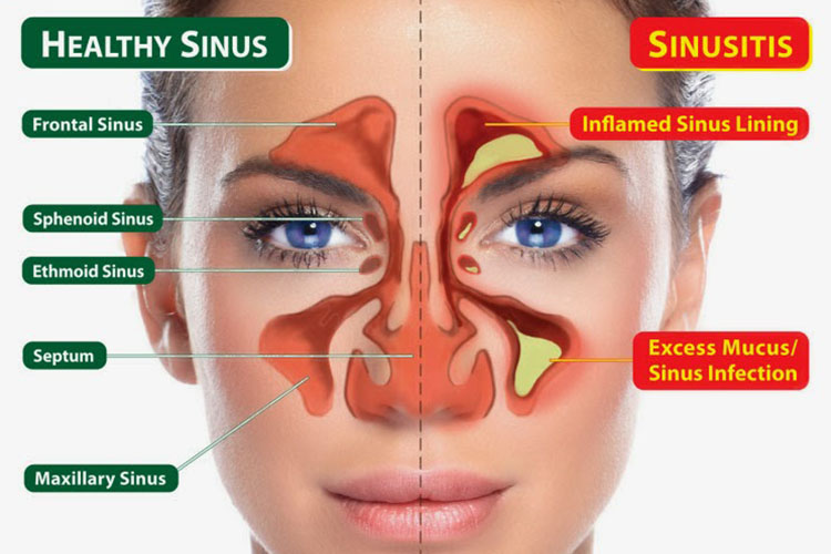 sinusitisandfibromyalgia