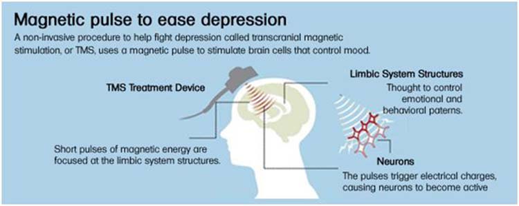 magneticstimulation