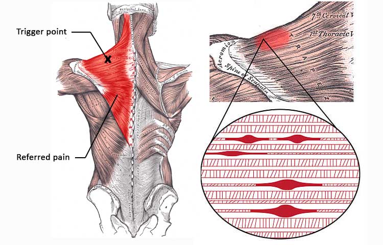 fibromyalgia trigger points