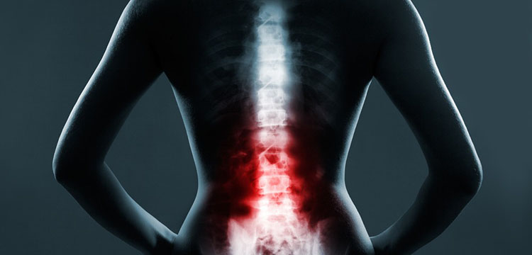 Cervical Spinal Stenosis In Fibromyalgia