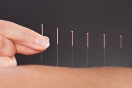 acupuncture for fibromyalgia